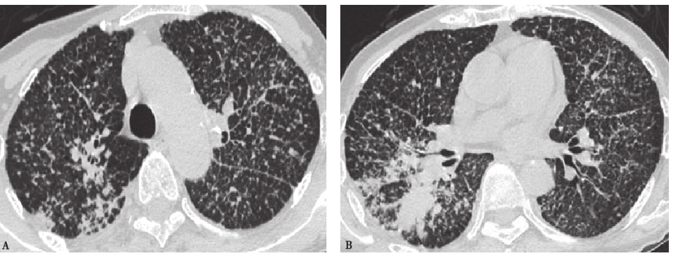 图6 肺腺癌肺内转移胸部CT表现.jpg